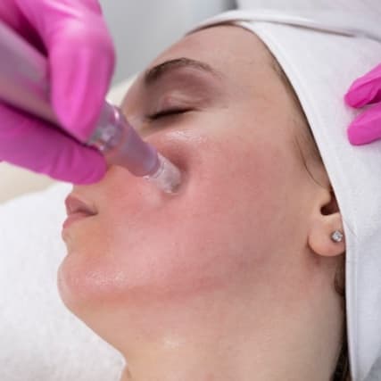 Microneedling SEVICES at Angel Threading and Sugar Wax Salon in Marietta, GA